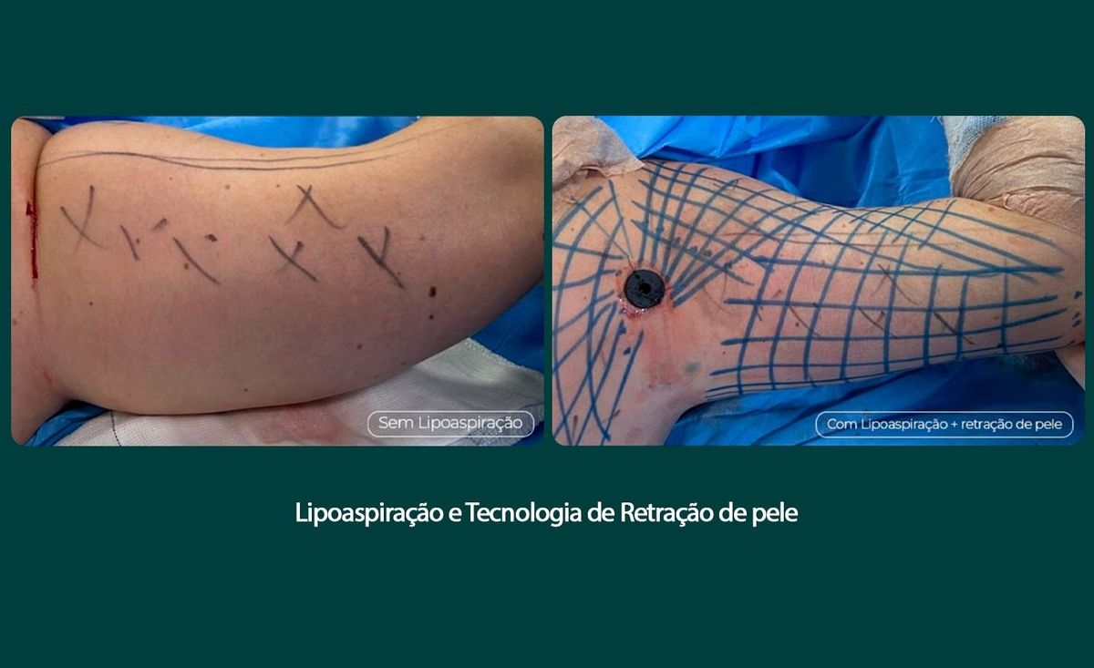 Tratamento remove flacidez do braço com tecnologia associada